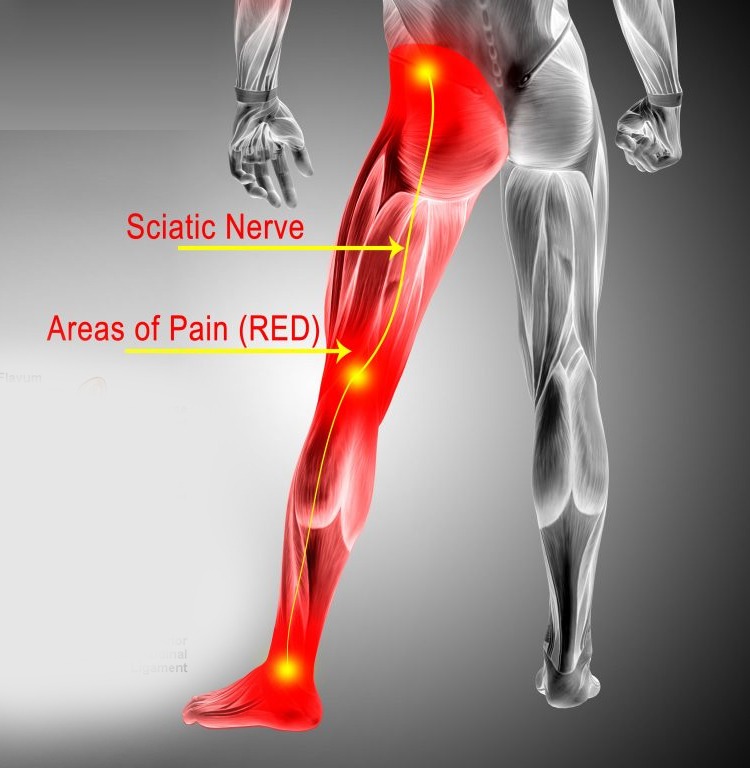 Sciatic Nerve Stretching: How To